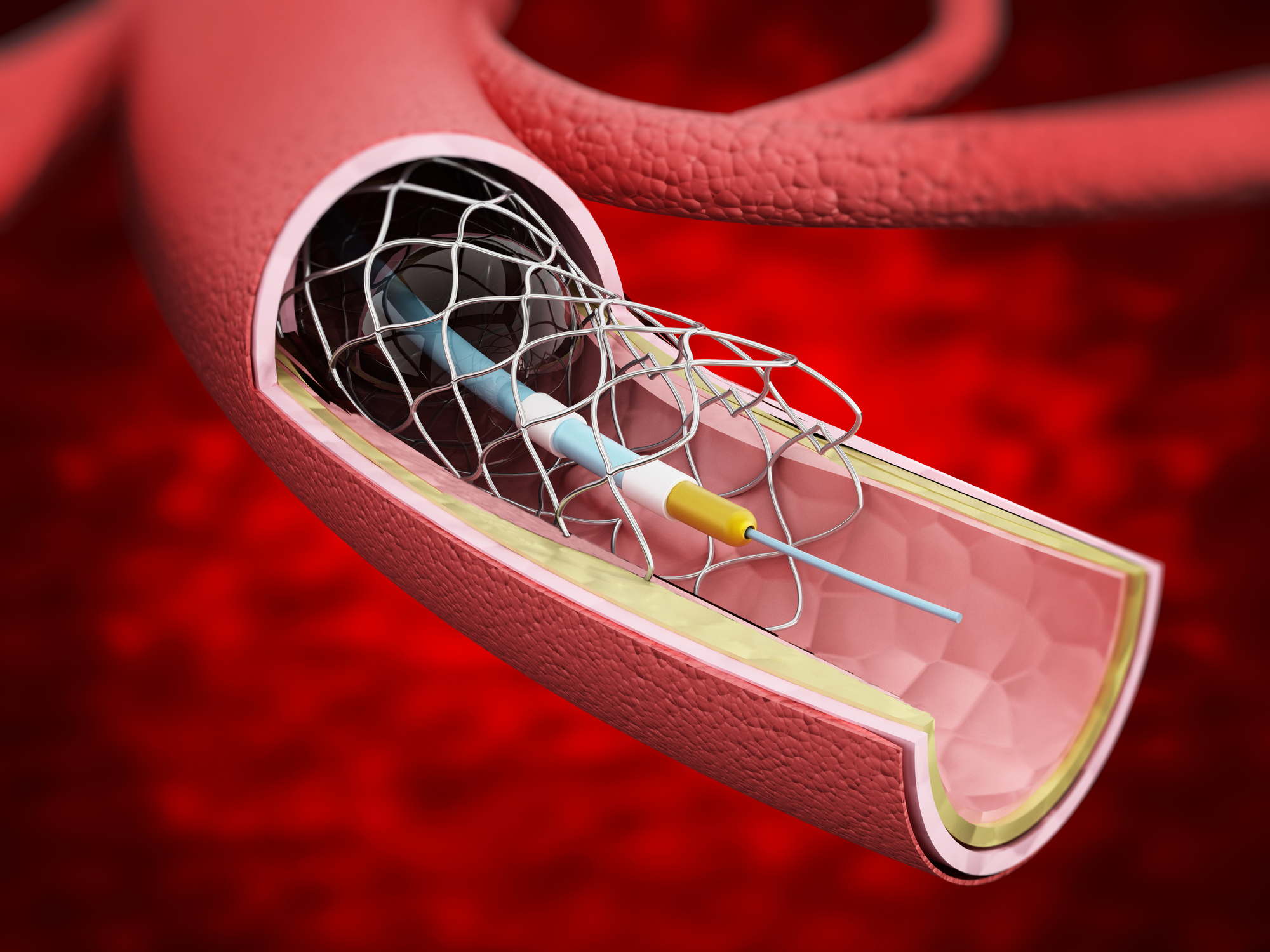 Illustration of a stent being expanded in an artery